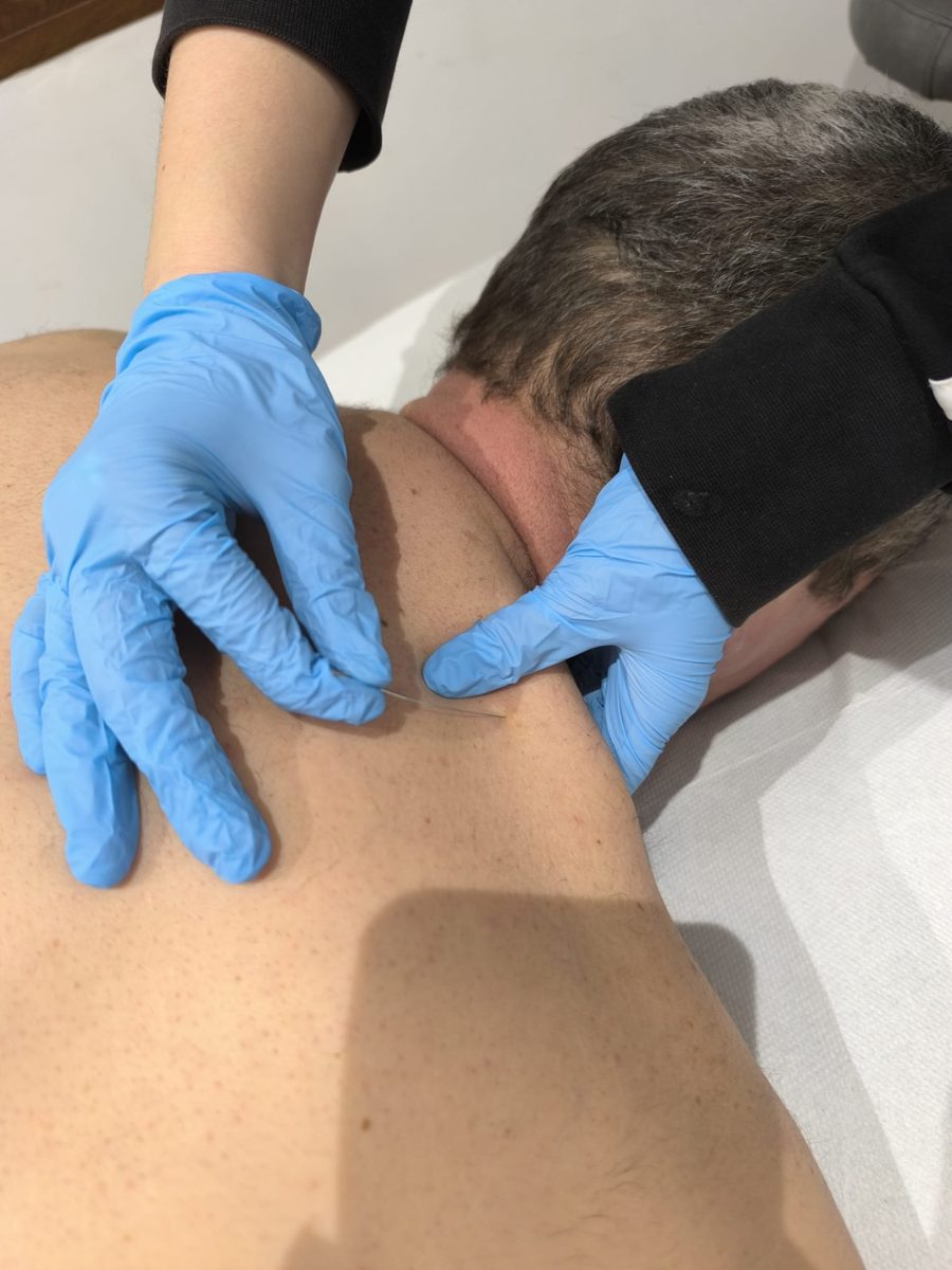 Terapia invasiva, punción seca